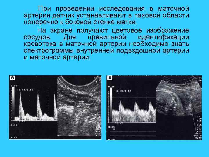 При проведении исследования в маточной артерии датчик устанавливают в паховой области поперечно к боковой