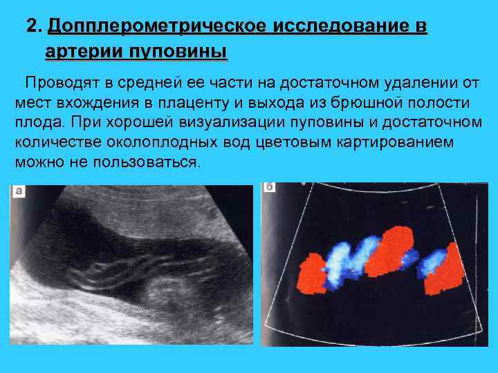 2. Допплерометрическое исследование в артерии пуповины Проводят в средней ее части на достаточном удалении