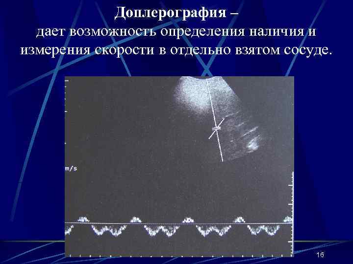 Доплерография – дает возможность определения наличия и измерения скорости в отдельно взятом сосуде. 16