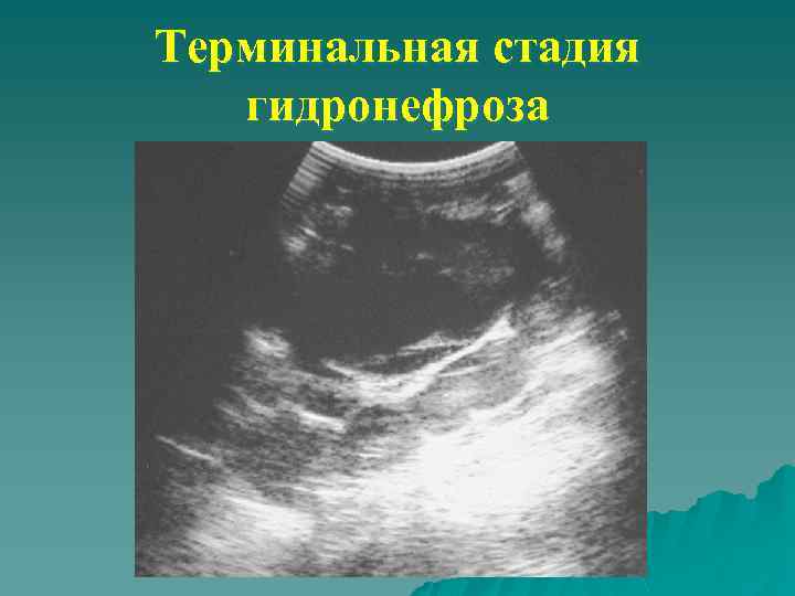 Терминальная стадия гидронефроза 
