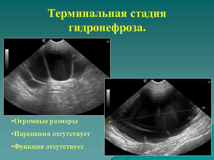 Терминальная стадия гидронефроза. • Огромные размеры • Паренхима отсутствует • Функция отсутствует 