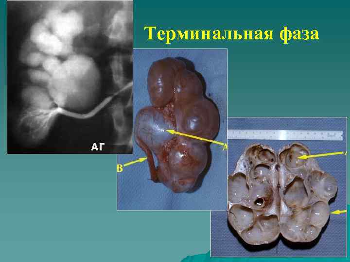 Терминальная фаза АГ 