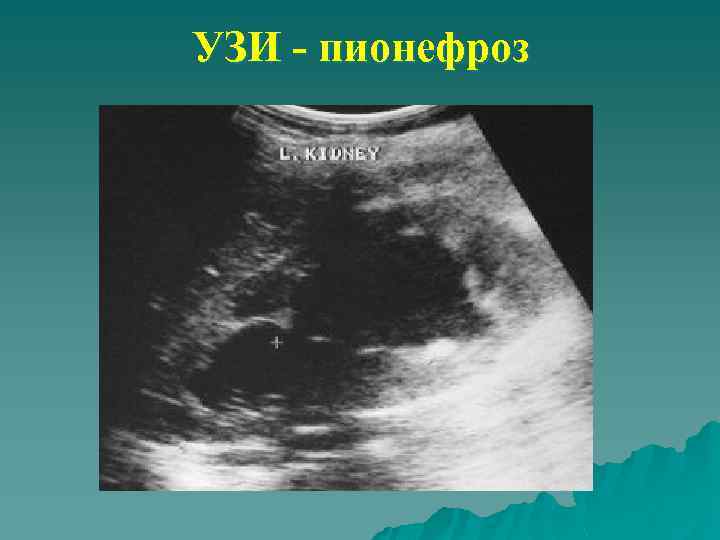 УЗИ - пионефроз 