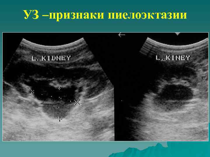 УЗ –признаки пиелоэктазии 