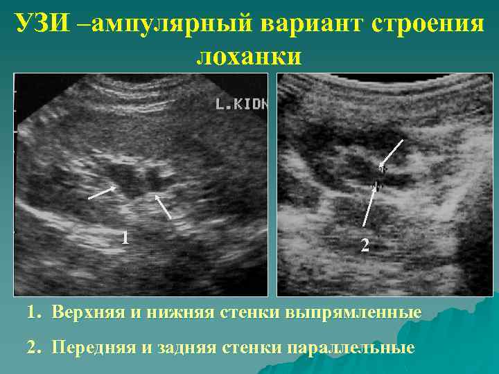 УЗИ –ампулярный вариант строения лоханки 1 2 1. Верхняя и нижняя стенки выпрямленные 2.