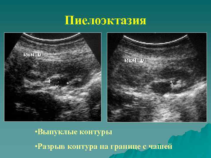 Пиелоэктазия • Выпуклые контуры • Разрыв контура на границе с чашей 