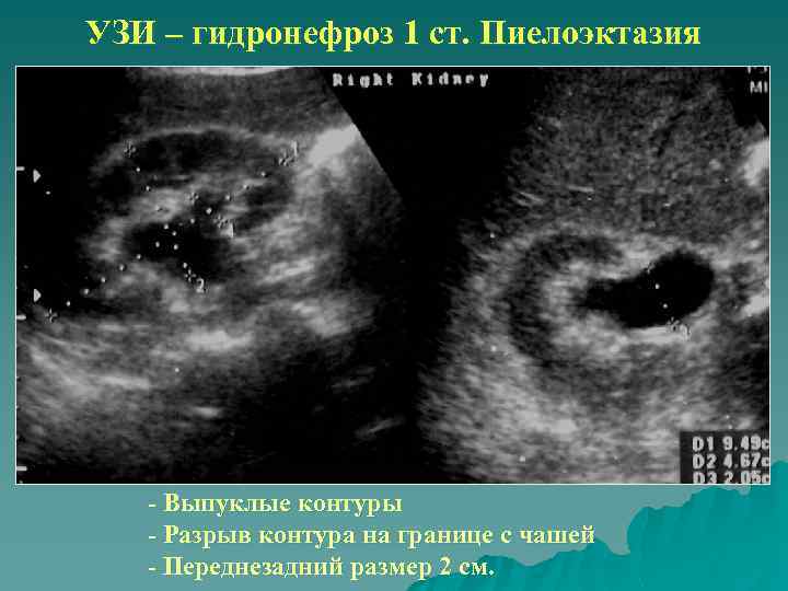 УЗИ – гидронефроз 1 ст. Пиелоэктазия - Выпуклые контуры - Разрыв контура на границе