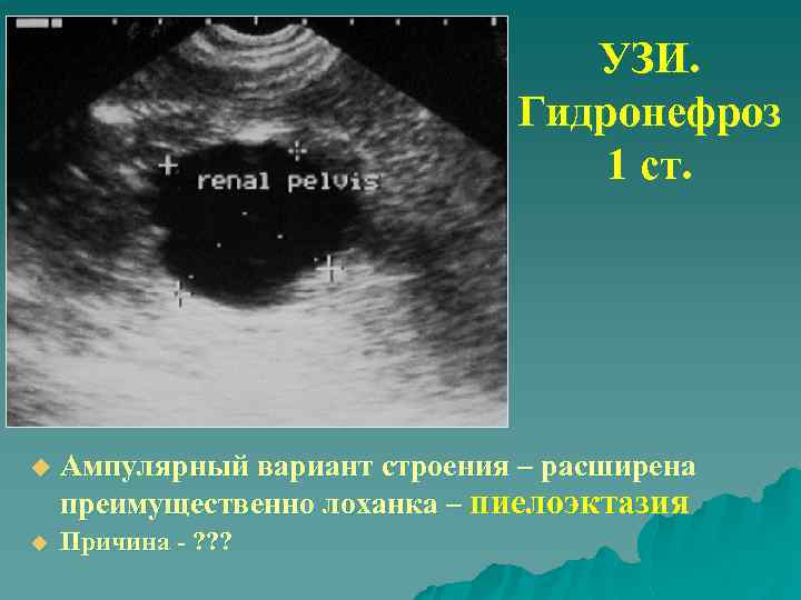 УЗИ. Гидронефроз 1 ст. u Ампулярный вариант строения – расширена преимущественно лоханка – пиелоэктазия