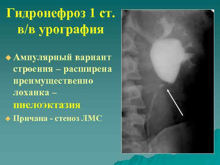 Гидронефроз 1 ст. в/в урография u Ампулярный вариант строения – расширена преимущественно лоханка –