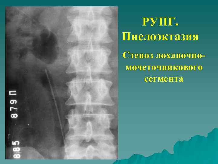 РУПГ. Пиелоэктазия Стеноз лоханочномочеточникового сегмента 