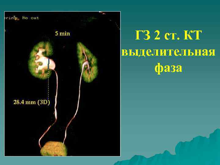 ГЗ 2 ст. КТ выделительная фаза 