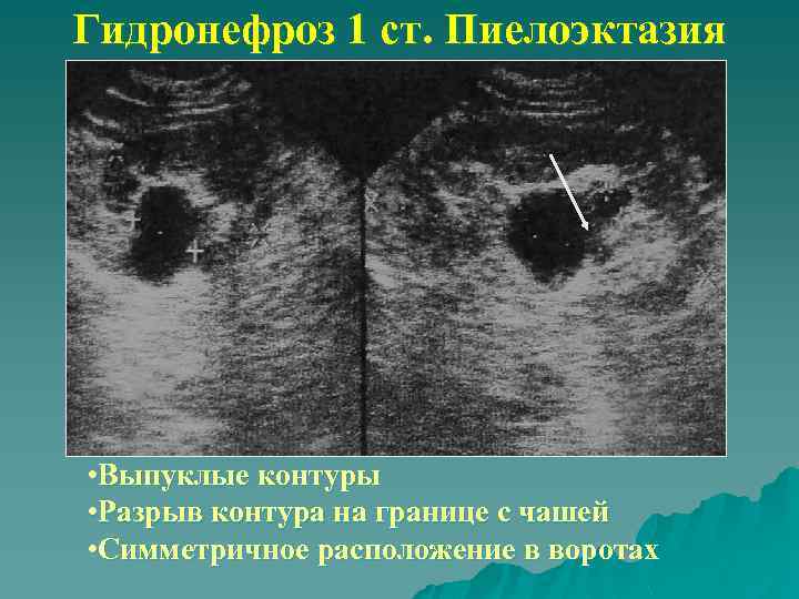 Гидронефроз 1 ст. Пиелоэктазия • Выпуклые контуры • Разрыв контура на границе с чашей