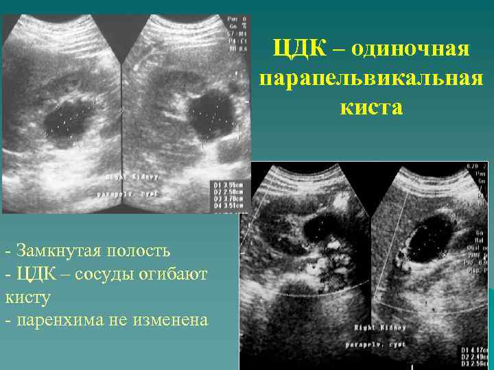 ЦДК – одиночная парапельвикальная киста - Замкнутая полость - ЦДК – сосуды огибают кисту