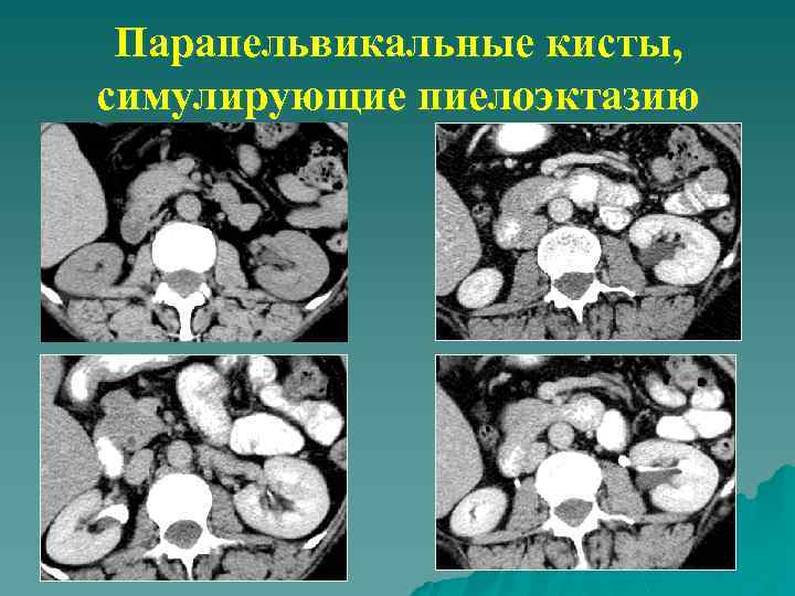 Парапельвикальные кисты, симулирующие пиелоэктазию 