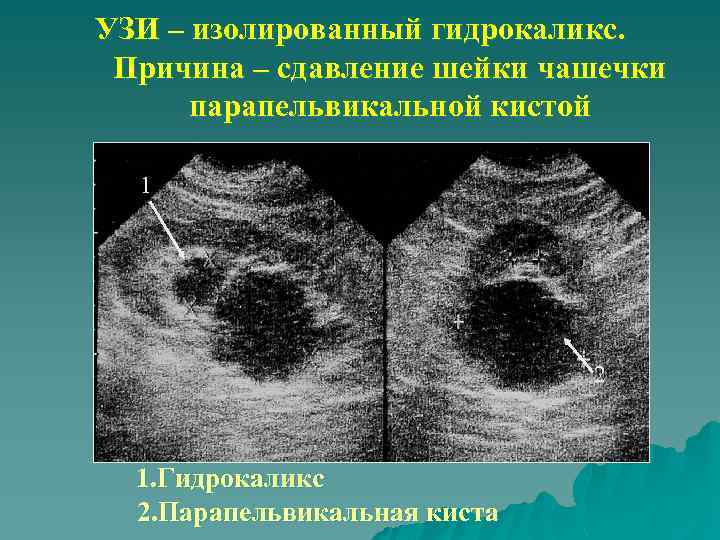 УЗИ – изолированный гидрокаликс. Причина – сдавление шейки чашечки парапельвикальной кистой 1 2 1.