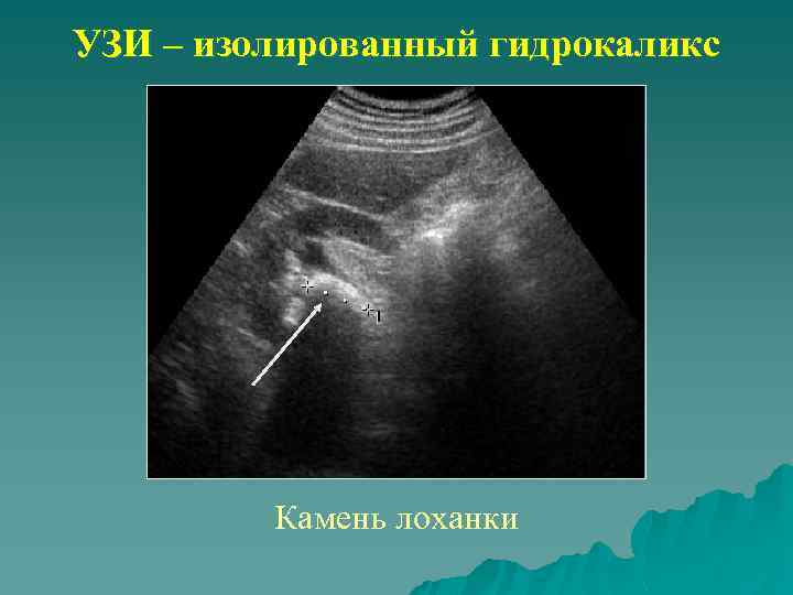 УЗИ – изолированный гидрокаликс Камень лоханки 