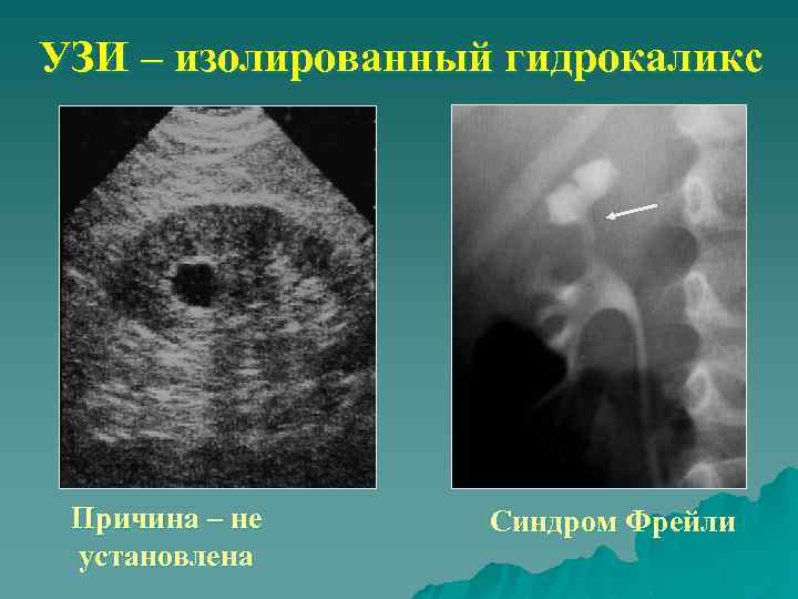 УЗИ – изолированный гидрокаликс Причина – не установлена Синдром Фрейли 
