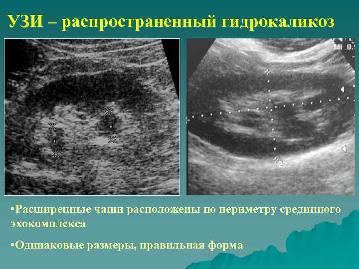 УЗИ – распространенный гидрокаликоз • Расширенные чаши расположены по периметру срединного эхокомплекса • Одинаковые