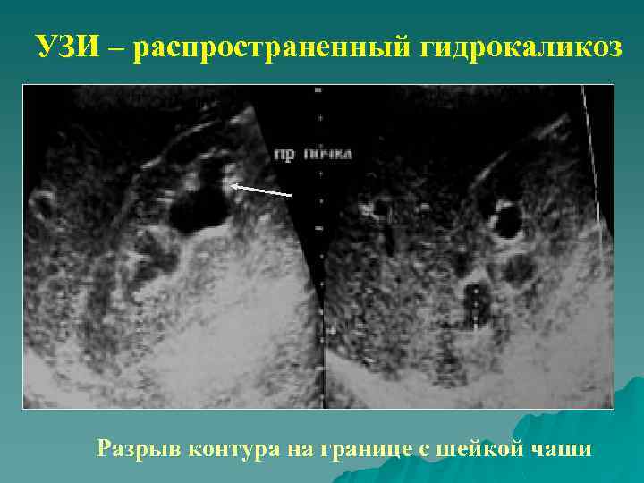 Уплотнение стенок члс по узи