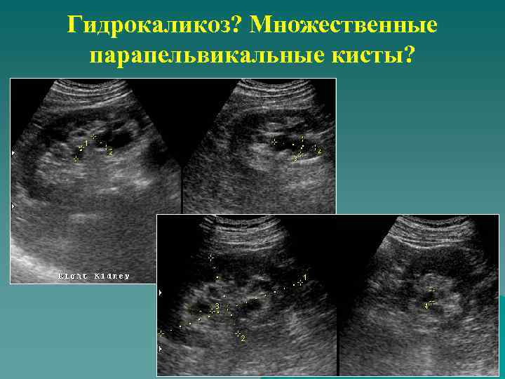 Гидрокаликоз? Множественные парапельвикальные кисты? 