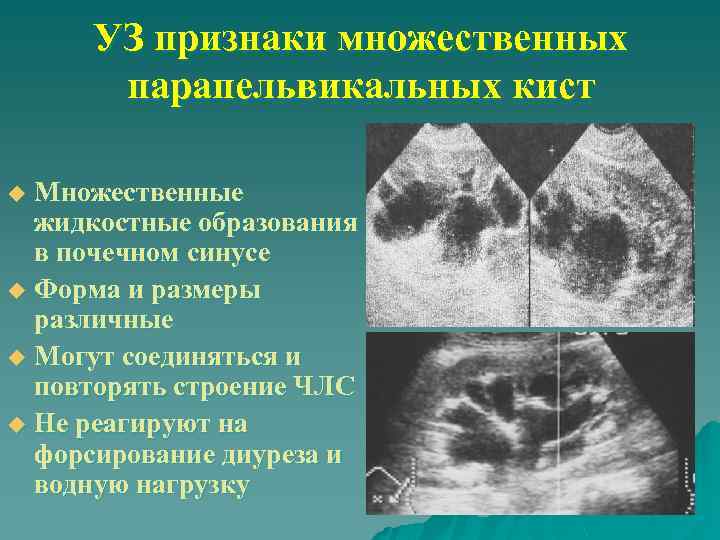 УЗ признаки множественных парапельвикальных кист Множественные жидкостные образования в почечном синусе u Форма и