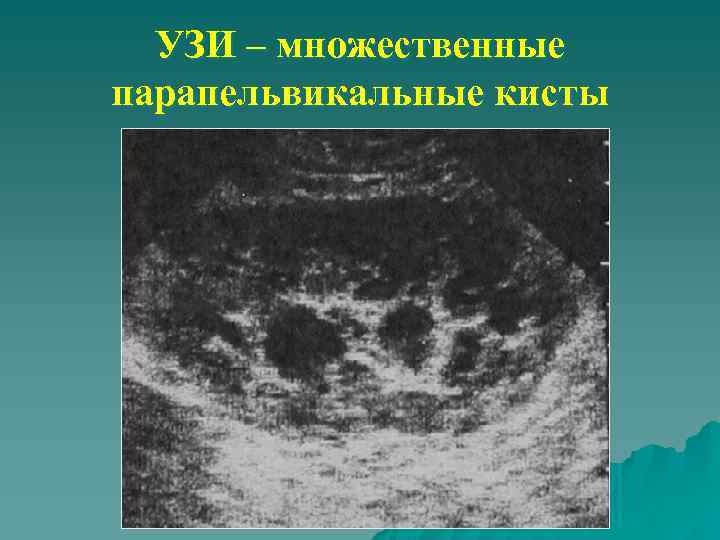 УЗИ – множественные парапельвикальные кисты 