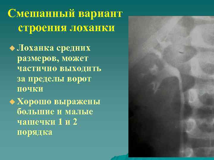 Смешанный вариант строения лоханки u Лоханка средних размеров, может частично выходить за пределы ворот