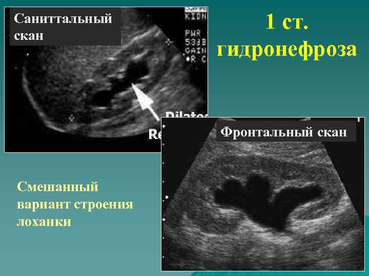 Саниттальный скан 1 ст. гидронефроза Фронтальный скан Смешанный вариант строения лоханки 