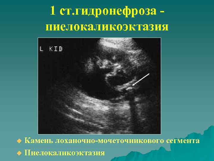 1 ст. гидронефроза пиелокаликоэктазия Камень лоханочно-мочеточникового сегмента u Пиелокаликоэктазия u 