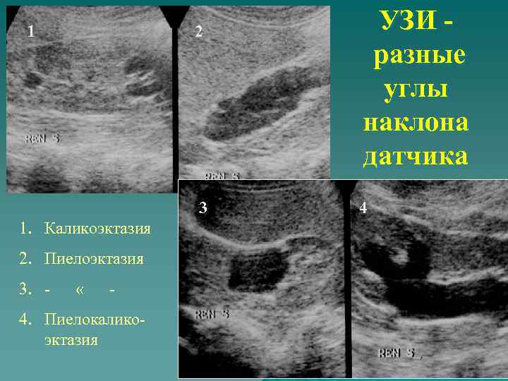 1 2 3 1. Каликоэктазия 2. Пиелоэктазия 3. - « - 4. Пиелокаликоэктазия УЗИ