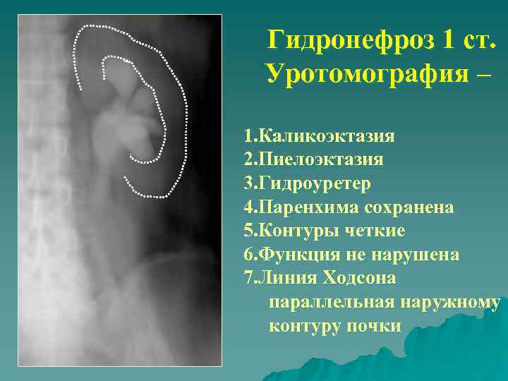 Гидронефроз 1 ст. Уротомография – 1. Каликоэктазия 2. Пиелоэктазия 3. Гидроуретер 4. Паренхима сохранена