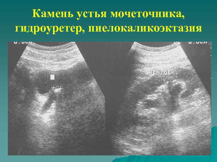Камень устья мочеточника, гидроуретер, пиелокаликоэктазия 