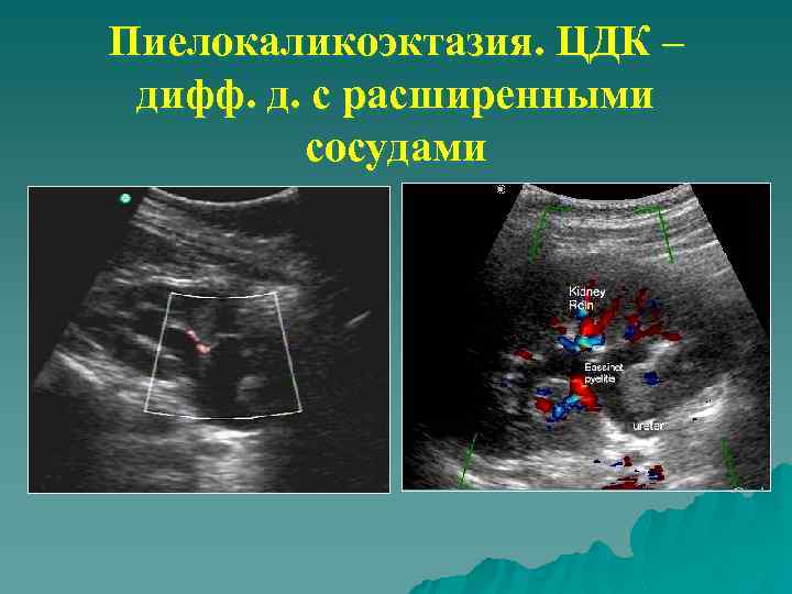 Пиелокаликоэктазия. ЦДК – дифф. д. с расширенными сосудами 