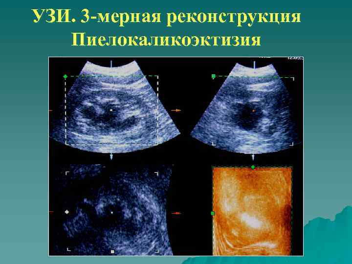 УЗИ. 3 -мерная реконструкция Пиелокаликоэктизия 