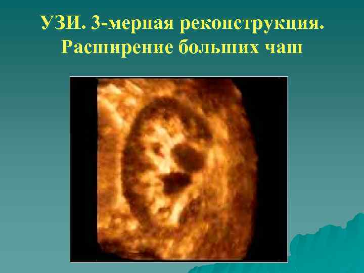 УЗИ. 3 -мерная реконструкция. Расширение больших чаш 