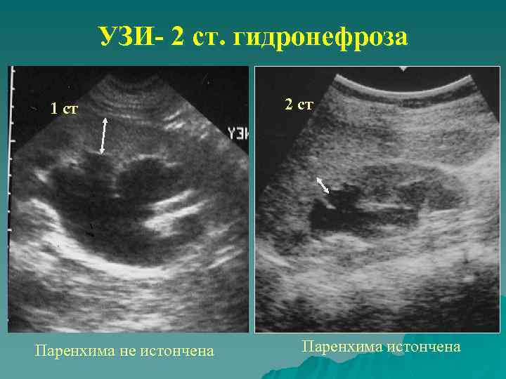 Узи гидронефроз фото