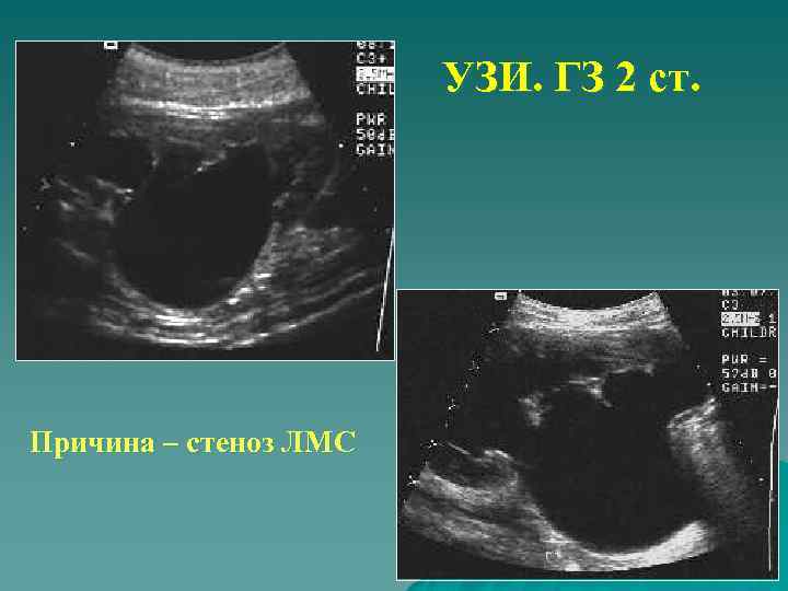 УЗИ. ГЗ 2 ст. Причина – стеноз ЛМС 