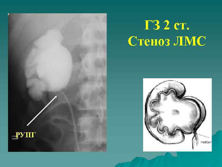 ГЗ 2 ст. Стеноз ЛМС РУПГ 