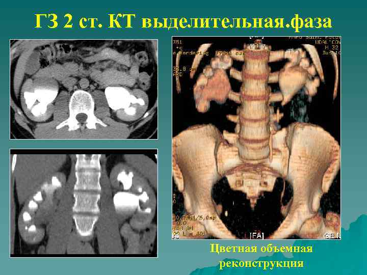 ГЗ 2 ст. КТ выделительная. фаза Цветная объемная реконструкция 