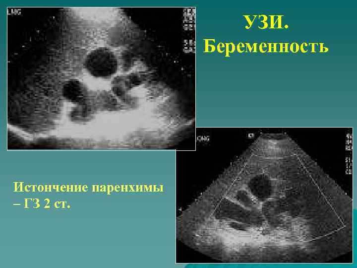 УЗИ. Беременность Истончение паренхимы – ГЗ 2 ст. 