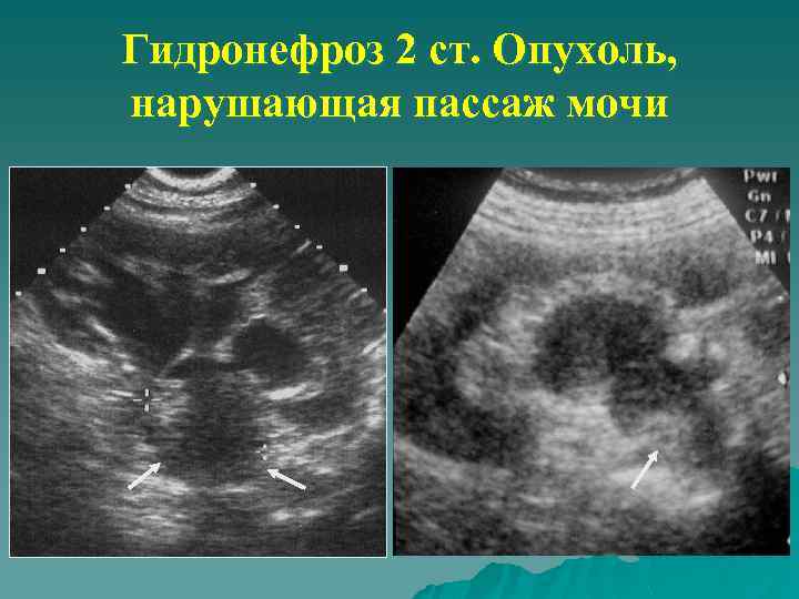 Гидронефроз 2 ст. Опухоль, нарушающая пассаж мочи 