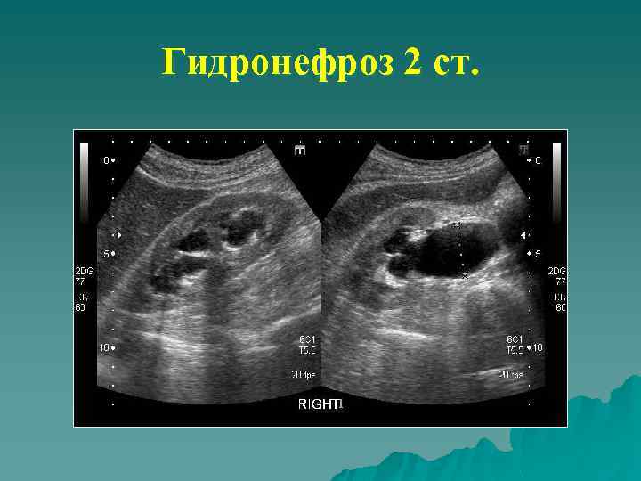 Гидронефроз 2 ст. 
