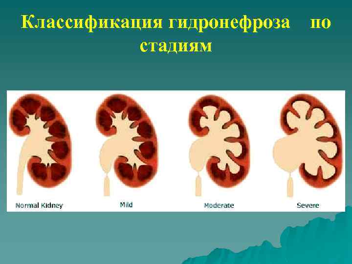 Гидронефроз у детей презентация