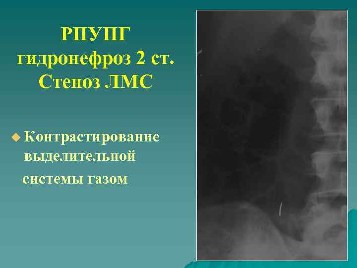 РПУПГ гидронефроз 2 ст. Стеноз ЛМС u Контрастирование выделительной системы газом 