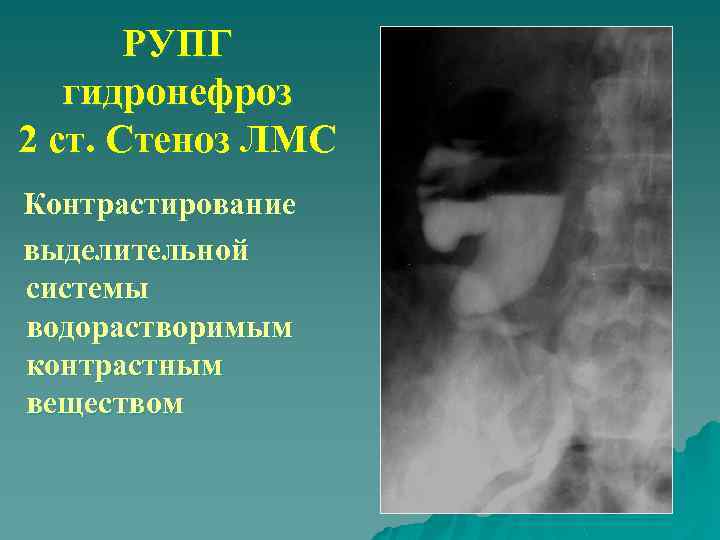 РУПГ гидронефроз 2 ст. Стеноз ЛМС Контрастирование выделительной системы водорастворимым контрастным веществом 