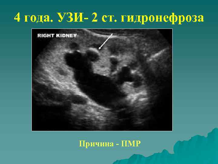 4 года. УЗИ- 2 ст. гидронефроза Причина - ПМР 