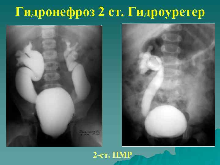 Гидронефроз клиническая картина