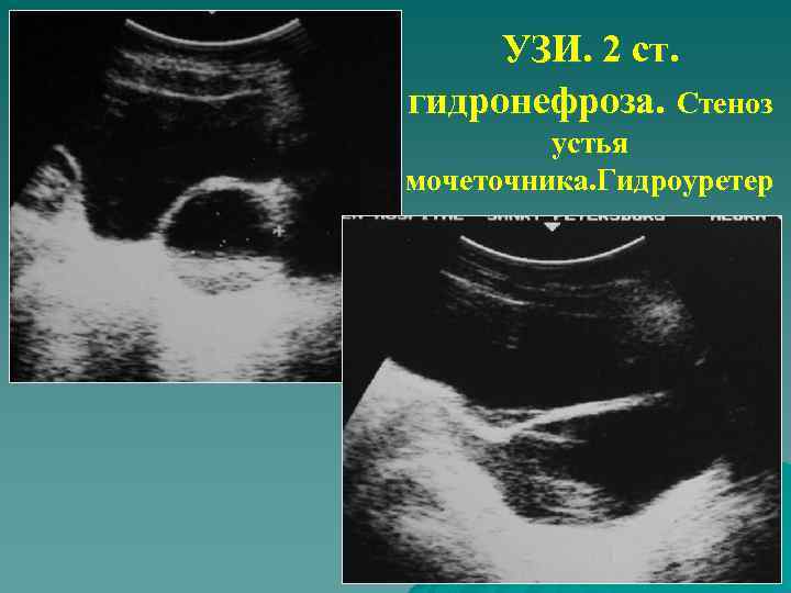 УЗИ. 2 ст. гидронефроза. Стеноз устья мочеточника. Гидроуретер 
