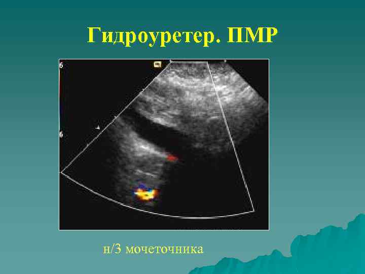 Гидроуретер. ПМР н/3 мочеточника 