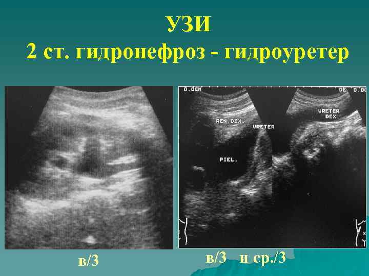 УЗИ 2 ст. гидронефроз - гидроуретер в/3 и ср. /3 